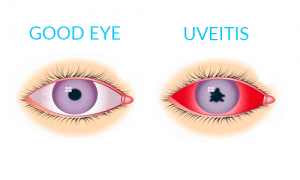 Image of two eyes, left one does not have any inflammation, right one indicates uveitis and a red sclera